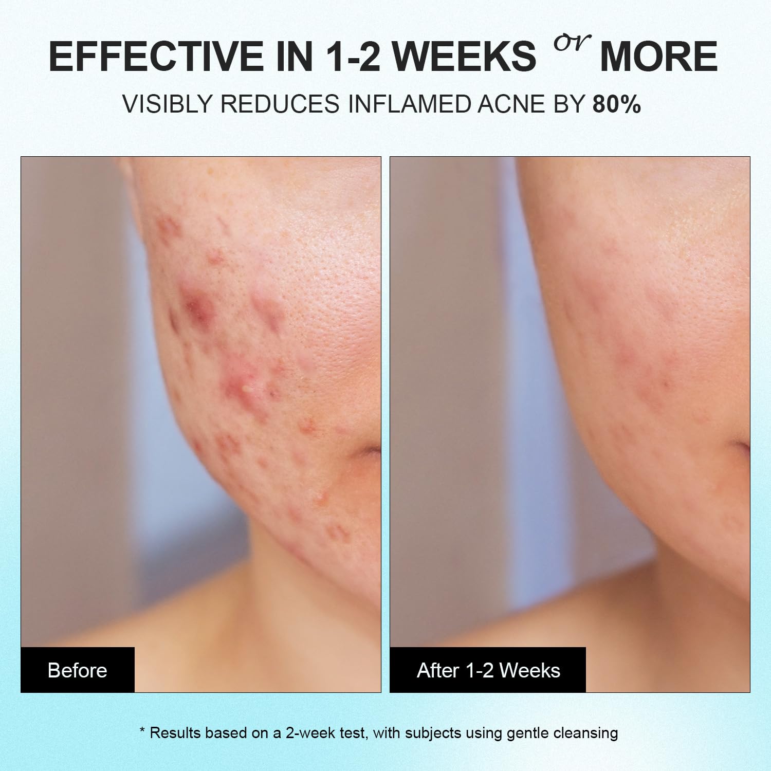 Creme para Acne - (Resultados em apenas 7 dias de uso)