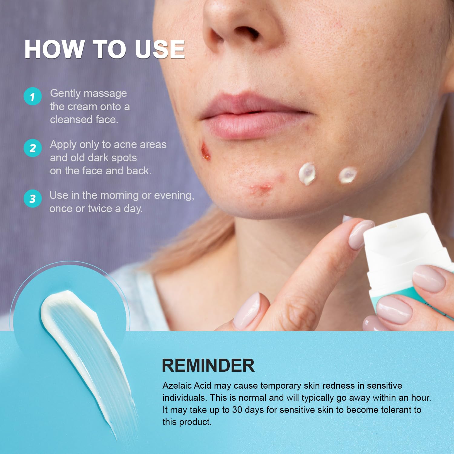 Creme para Acne - (Resultados em apenas 7 dias de uso)