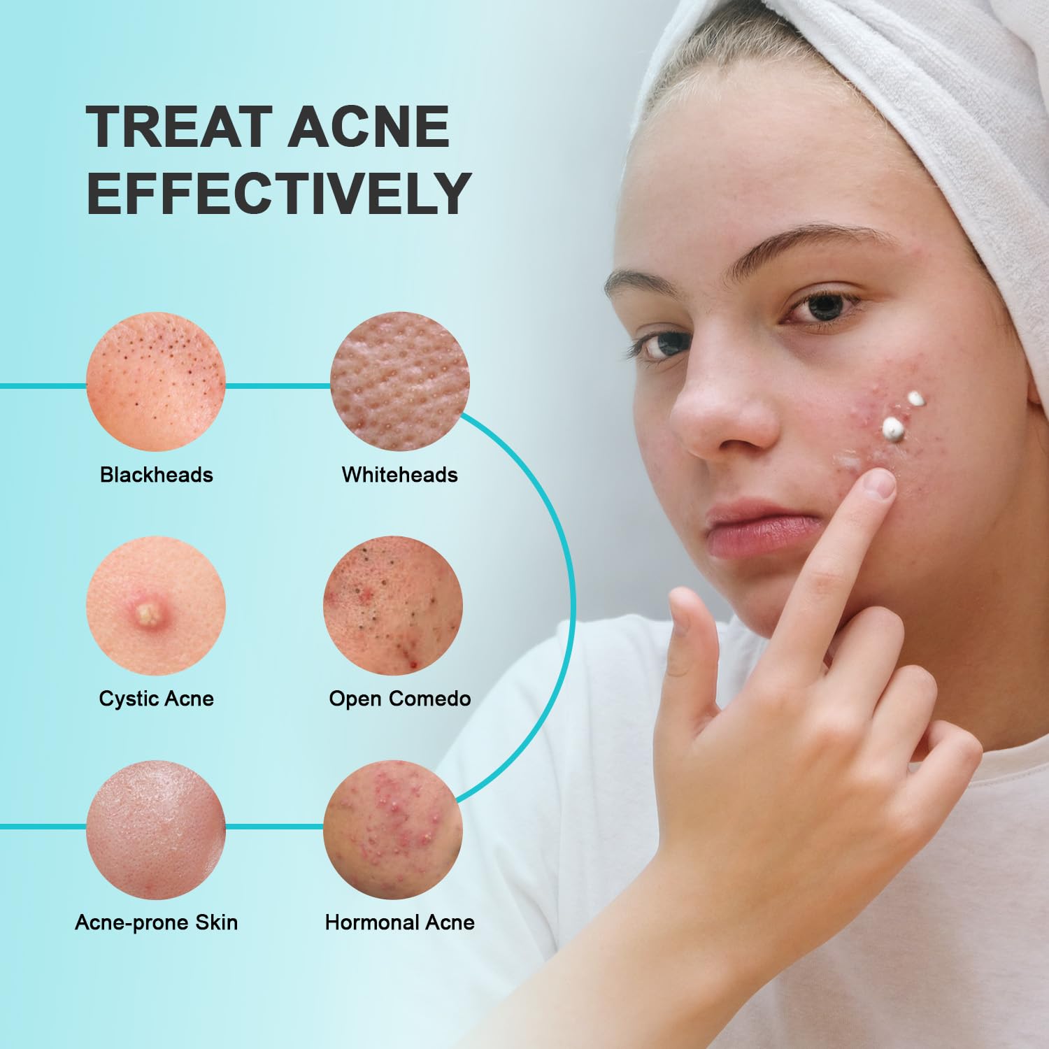 Creme para Acne - (Resultados em apenas 7 dias de uso)